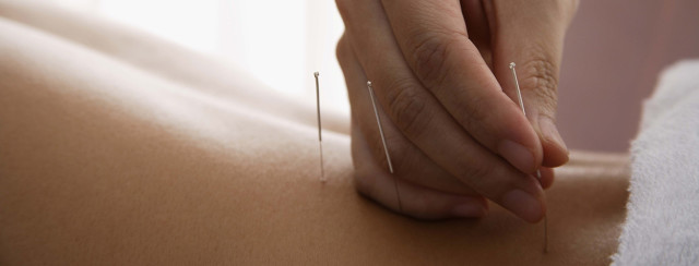 Dry Needle Therapy